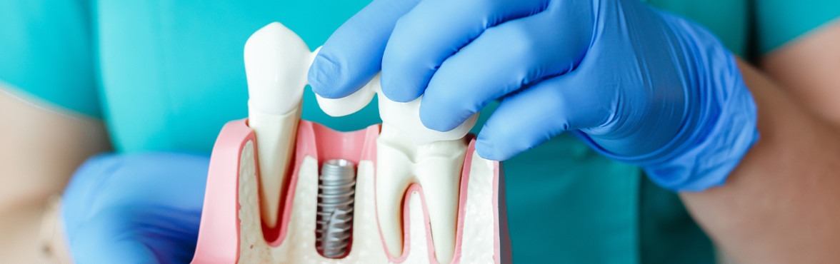 como cuidar dos seus implantes